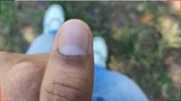 চাকসু ভোটে হাতে দেওয়া কালি মুছে যাচ্ছে