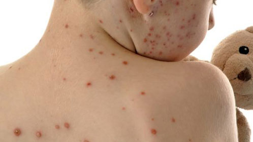 পাবনায় হঠাৎ হামের প্রাদুর্ভাব: হাসপাতালে ভর্তি ২৭ রোগী